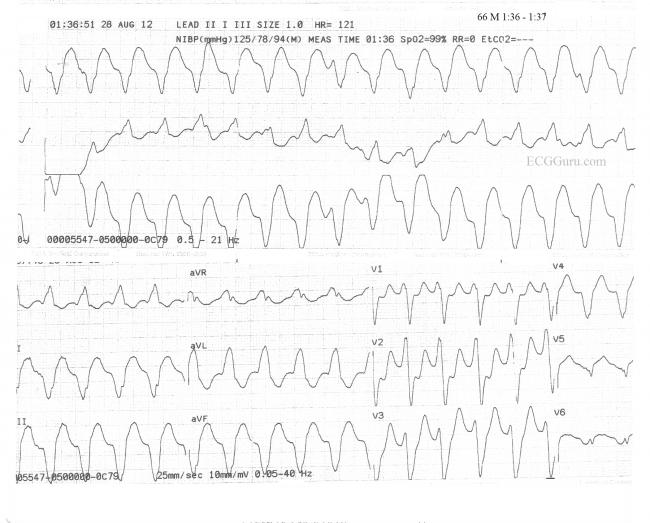 V Tach ECG Guru Instructor Resources
